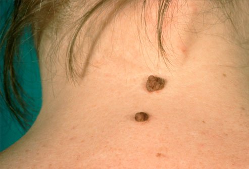Moles on back of neck