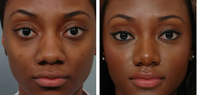 African American Nose surgery