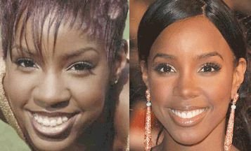 African American Rhinoplasty Before and After - Kelly
