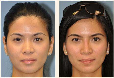 Asian Rhinoplasty with Defined Tip - Before and After