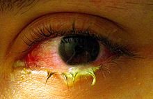 Bacterial Pink eye – Causes, Symptoms, Treatment and Prevention