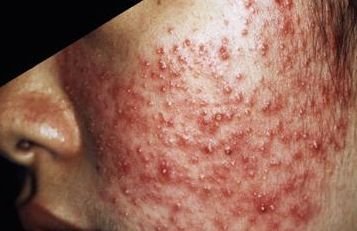 Best Ways to Get Rid of Acne Scars