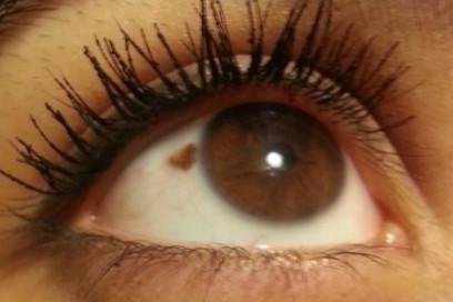 Birth mark in the eye