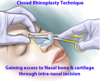 Closed Rhinoplasty Technique