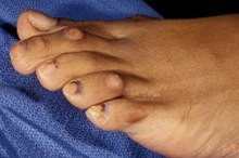 Corns on toes