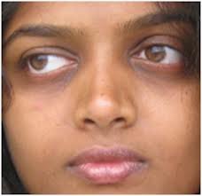 Dark Circles Under Eyes Causes – What Is and Why They Come