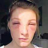 Eyebrow Dyes - Risks, Dangers and Side Effects of Using Eyebrow Dyes