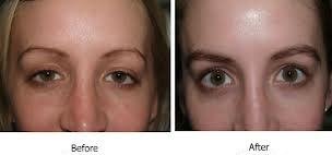Eyebrow Implants Before and After
