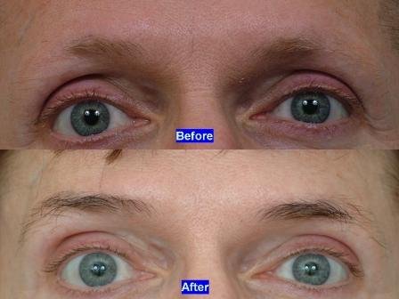 Eyebrow Loss – Cure and Treatment of Eyebrows Before and After