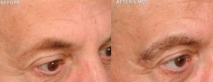Eyebrow Transplant - Before and After