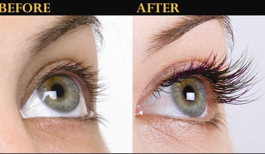 How to Get Rid Of Stretch Marks Naturally, Remove Stretch Marks Fast and Home Remedies