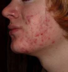 Foods that Cause Acne – Which Foods Cause, Prevent, Cure, Help, and Reduce Acne Breakout on Adults and Teenagers - Acne Breakout