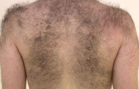 Hair grows on all parts of men exept the forehead