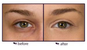 How to Apply Under Eye Concealers - Before ApplyingUnder Eye Concealer and After
