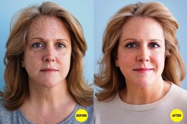 How to Fade Freckles with Products