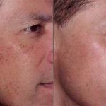 How to Get Rid of Dark Circles under Eyes – Laser Resurfacing before and AfterTreatments