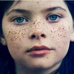 How to Get Rid of Freckles on Face