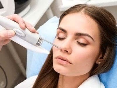 Laser mole removal fom the face