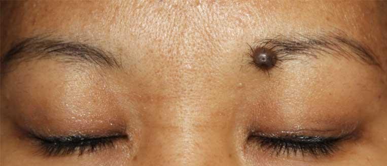 Moles on eyebrow