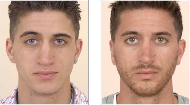 Nose Surgery – Costs, Recovery, Before and After Pictures