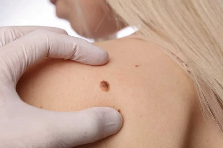 Precancerous Mole