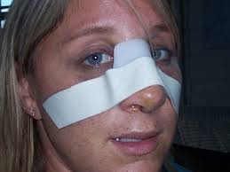 Rhinoplasty Recovery – Timeline, Revision, Photos and Tips - Rhinoplasty Recovery Day 6