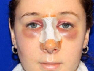 Rhinoplasty Recovery Time, Nose Job Recovery Time, Tip, Open, Asian and Revision