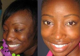 Skin Whitening Home Remedies - Before and after for dark skin