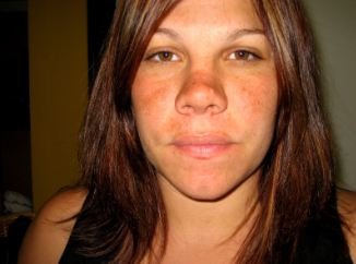 Swollen Nose – Causes, Red, On Bridge, Nose Tip and During Pregnancy - Pregnancy