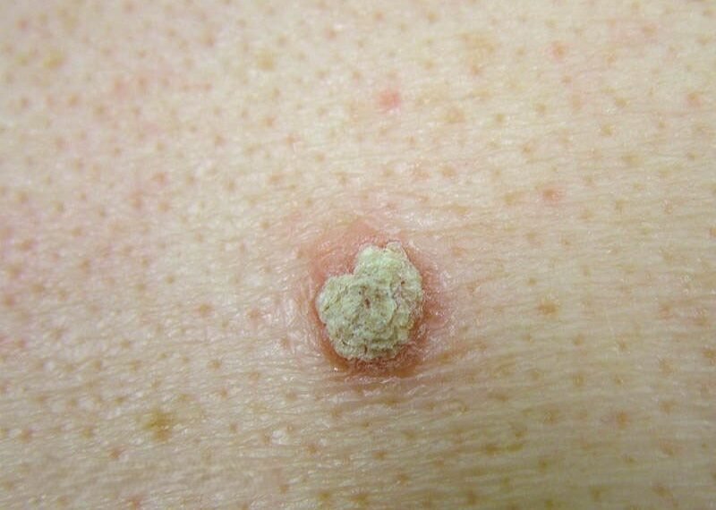 White mole on skin