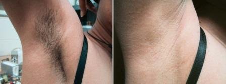 Brazilian under arm laser hair removal