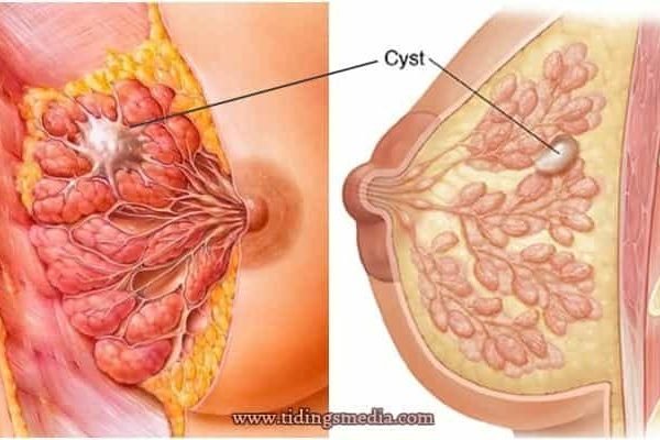 Lump in breast - cyst