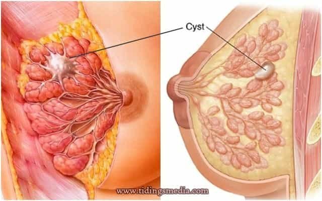 Lump in breast - cyst