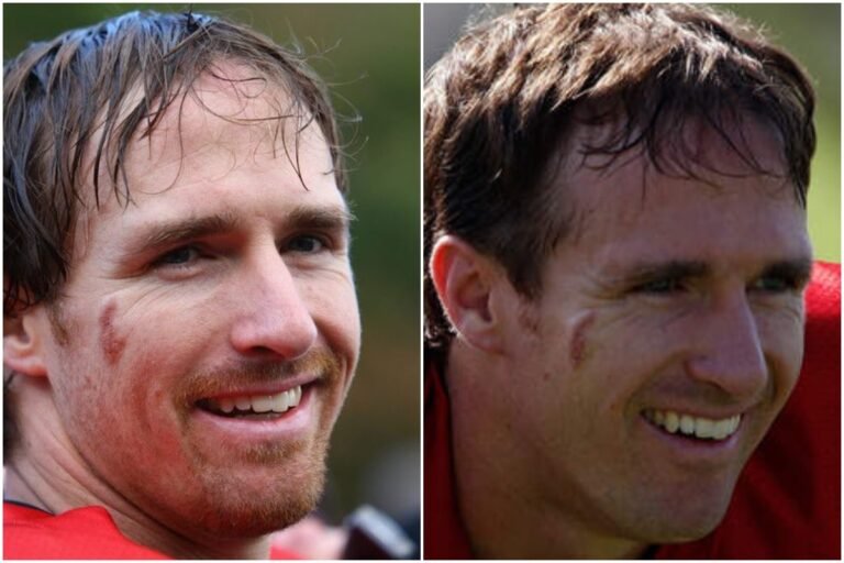 Drew Brees' Birthmark