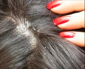 Dry scalp