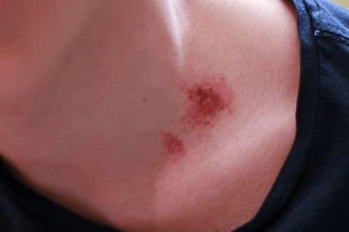 how long does a hickey last on neck