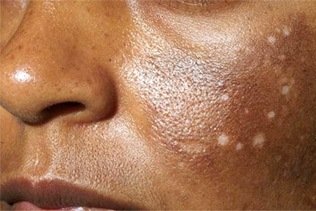 Hypo-pigmentation is one of the side effects