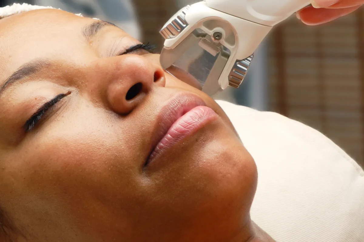 laser treatment on face