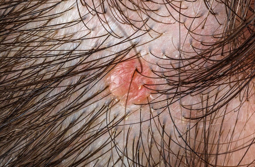Mole on scalp