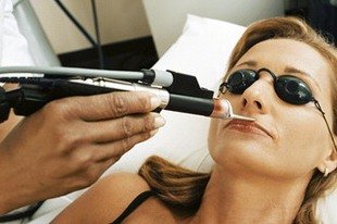 Upper lip laser hair removal