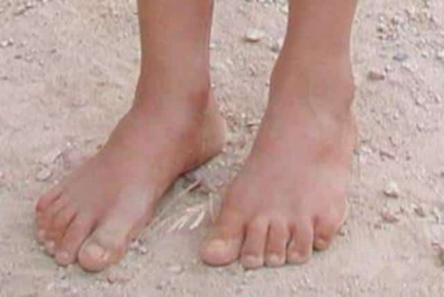 Walking barefoot may cause corns of your feet